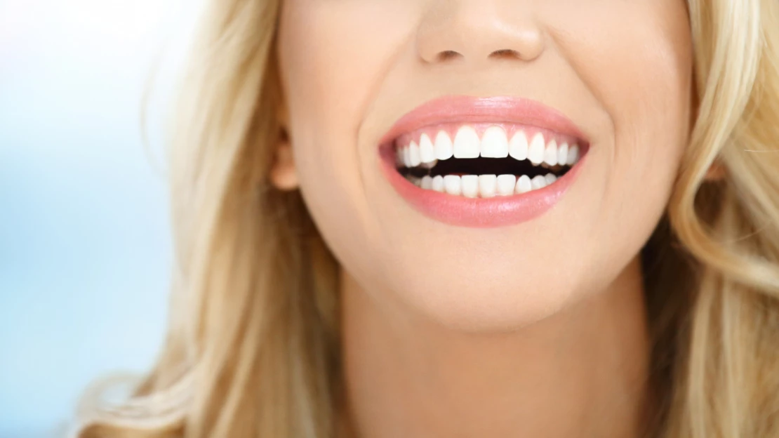 SEO Bonding Veneers